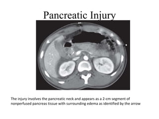 Pancreatic Injury
The injury involves the pancreatic neck and appears as a 2-cm segment of
nonperfused pancreas tissue with surrounding edema as identified by the arrow
 