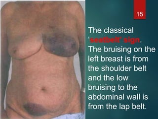 The classical
‘seatbelt’ sign.
The bruising on the
left breast is from
the shoulder belt
and the low
bruising to the
abdominal wall is
from the lap belt.
15
 