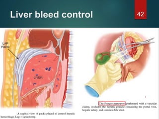 Liver bleed control 42
 