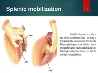 Splenic mobilization 44
 
