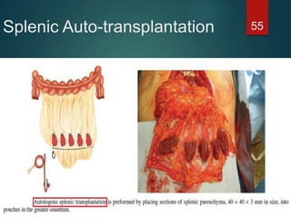 Splenic Auto-transplantation 55
 