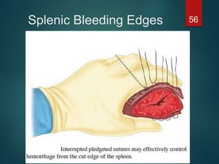 Splenic Bleeding Edges 56
 