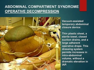 ABDOMINAL COMPARTMENT SYNDROME
OPERATIVE DECOMPRESSION
Vacuum-assisted
temporary abdominal
closure device:
Thin plastic sheet, a
sterile towel, closed
suction drains, and a
large adherent
operative drape. This
dressing system
permits increases in
intra-abdominal
volume, without a
dramatic elevation in
IAP.
 