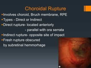 Blunt trauma & blow out fracture | PPTX