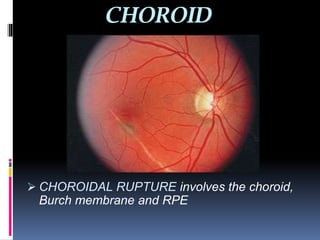 Blunt Ocular Trauma | PDF