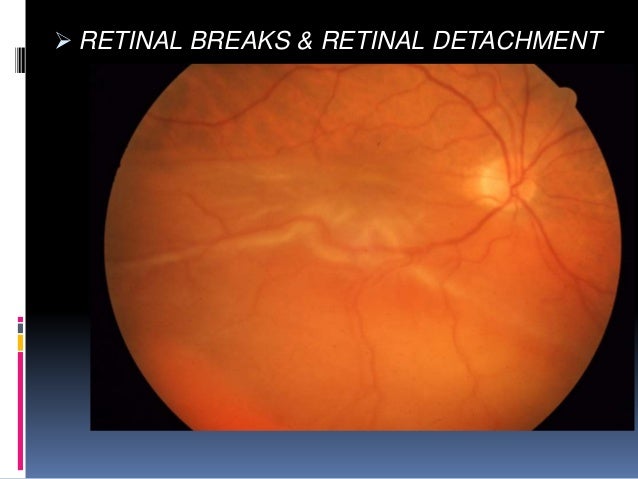 Blunt Ocular Trauma Blunt Ocular Trauma