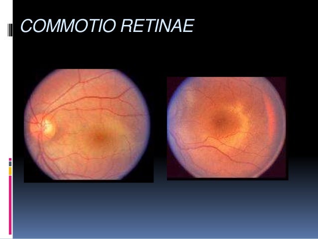Blunt Ocular Trauma