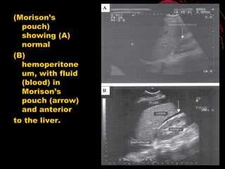 (Morison’s
pouch)
showing (A)
normal
(B)
hemoperitone
um, with fluid
(blood) in
Morison’s
pouch (arrow)
and anterior
to the liver.
 