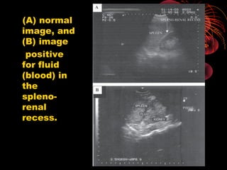 (A) normal
image, and
(B) image
positive
for fluid
(blood) in
the
spleno-
renal
recess.
 
