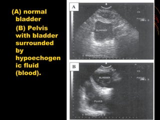 (A) normal
bladder
(B) Pelvis
with bladder
surrounded
by
hypoechogen
ic fluid
(blood).
 