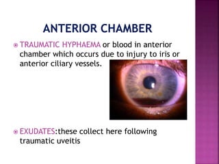  TRAUMATIC HYPHAEMA or blood in anterior
chamber which occurs due to injury to iris or
anterior ciliary vessels.
 EXUDATES:these collect here following
traumatic uveitis
 