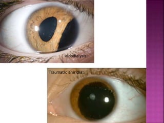 iridodialysis:
Traumatic aniridia:
 
