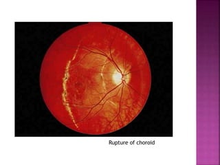 Rupture of choroid
 