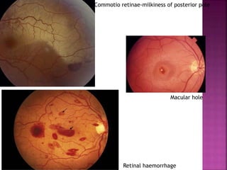 Commotio retinae-milkiness of posterior pole
Retinal haemorrhage
Macular hole
 