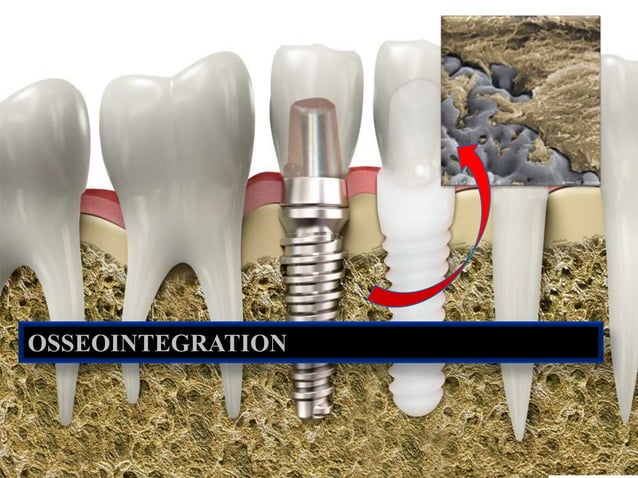 Osseointegration | PPTX | Bone and Joint Conditions | Diseases and ...