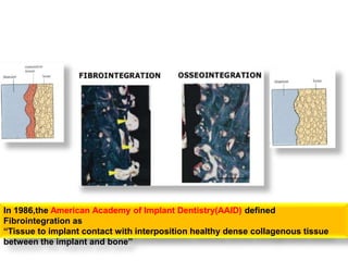In 1986,the American Academy of Implant Dentistry(AAID) defined
Fibrointegration as
“Tissue to implant contact with interposition healthy dense collagenous tissue
between the implant and bone’’
 