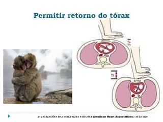Permitir retorno do tórax
ATUALIZAÇÕES DAS DIRETRIZES PARA RCP American Heart Associations e ACLS 2020
 