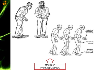 MARCHA
PARKINSONIANA
 