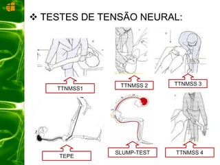  TESTES DE TENSÃO NEURAL:
TTNMSS1
TEPE
SLUMP-TEST TTNMSS 4
TTNMSS 3TTNMSS 2
 