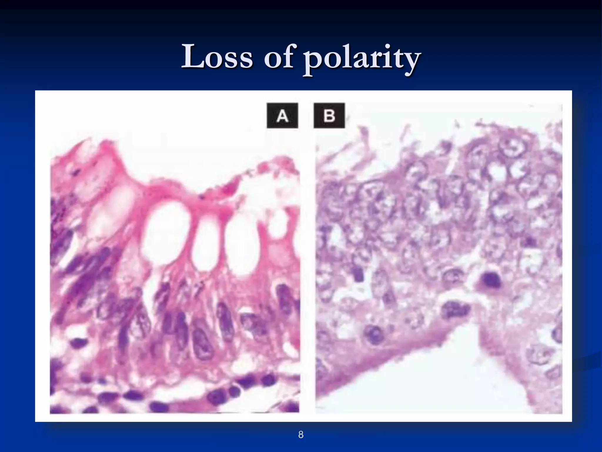 NEOPLASIA: Grading and Staging & Laboratory Diagnosis of Cancer | PPT