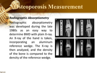  Radiographic Absorptiometry
• Radiographic absorptiometry
was developed during the late
1980s as an easy way to
determine BMD with plain X-ray.
An X-ray of the hand is taken,
incorporating an aluminum
reference wedge. The X-ray is
then analyzed, and the density
of the bone is compared to the
density of the reference wedge.
Osteoporosis Measurement
 