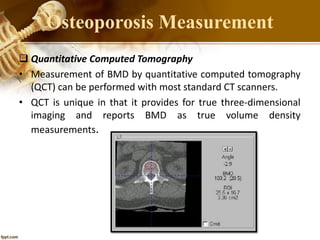  Quantitative Computed Tomography
• Measurement of BMD by quantitative computed tomography
(QCT) can be performed with most standard CT scanners.
• QCT is unique in that it provides for true three-dimensional
imaging and reports BMD as true volume density
measurements.
Osteoporosis Measurement
 