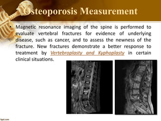 Osteoporosis Measurement
• Magnetic resonance imaging of the spine is performed to
evaluate vertebral fractures for evidence of underlying
disease, such as cancer, and to assess the newness of the
fracture. New fractures demonstrate a better response to
treatment by Vertebroplasty and Kyphoplasty in certain
clinical situations.
 