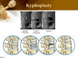 Kyphoplasty
 