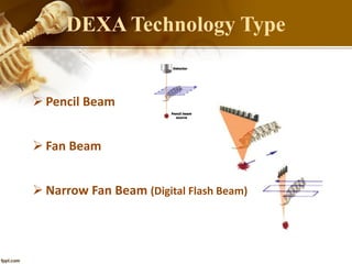 DEXA Technology Type
 Pencil Beam
 Fan Beam
 Narrow Fan Beam (Digital Flash Beam)
 