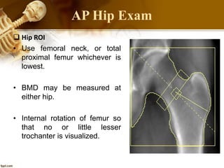  Hip ROI
• Use femoral neck, or total
proximal femur whichever is
lowest.
• BMD may be measured at
either hip.
• Internal rotation of femur so
that no or little lesser
trochanter is visualized.
AP Hip Exam
 