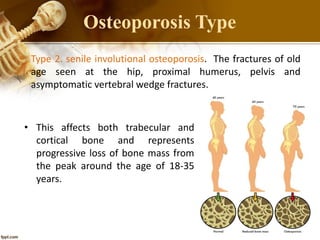 • Type 2. senile involutional osteoporosis. The fractures of old
age seen at the hip, proximal humerus, pelvis and
asymptomatic vertebral wedge fractures.
Osteoporosis Type
• This affects both trabecular and
cortical bone and represents
progressive loss of bone mass from
the peak around the age of 18-35
years.
 