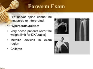 Forearm Exam
• Hip and/or spine cannot be
measured or interpreted.
• Hyperparathyroidism
• Very obese patients (over the
weight limit for DXA table)
• Metallic devices in exam
region
• Children
 