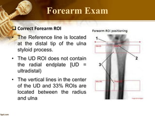 Forearm Exam
 Correct Forearm ROI
• The Reference line is located
at the distal tip of the ulna
styloid process.
• The UD ROI does not contain
the radial endplate [UD =
ultradistal)
• The vertical lines in the center
of the UD and 33% ROIs are
located between the radius
and ulna
 
