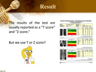 Result
The results of the test are
usually reported as a "T score"
and "Z score.“
But we use T or Z score?
 