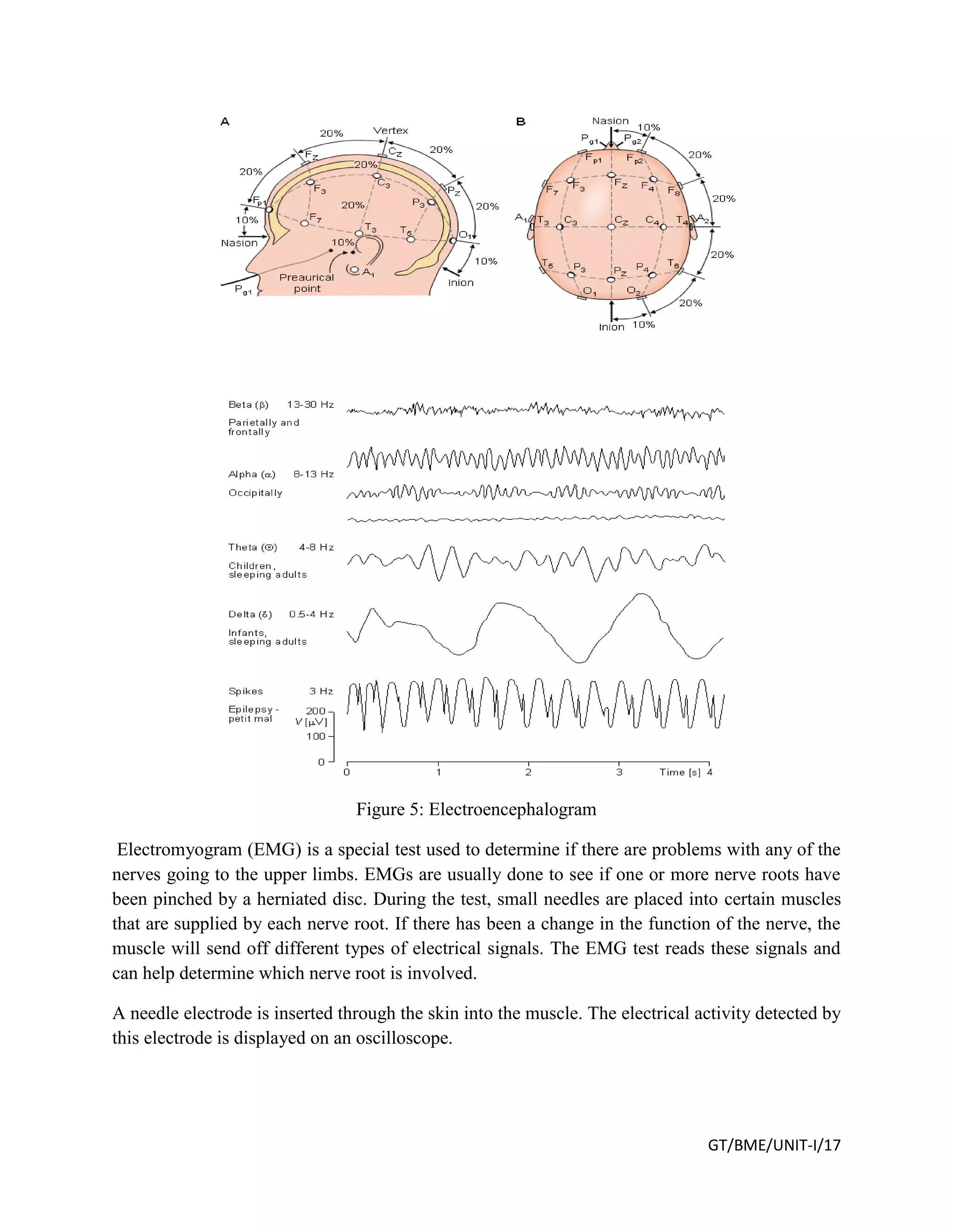 GT/BME/UNIT-I/17
Figure 5: Electroencephalogram
Electromyogram (EMG) is a special test used to determine if there are problems with any of the
nerves going to the upper limbs. EMGs are usually done to see if one or more nerve roots have
been pinched by a herniated disc. During the test, small needles are placed into certain muscles
that are supplied by each nerve root. If there has been a change in the function of the nerve, the
muscle will send off different types of electrical signals. The EMG test reads these signals and
can help determine which nerve root is involved.
A needle electrode is inserted through the skin into the muscle. The electrical activity detected by
this electrode is displayed on an oscilloscope.
 