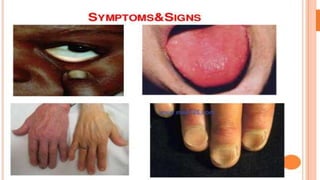 Signs and symptoms of anemia
 