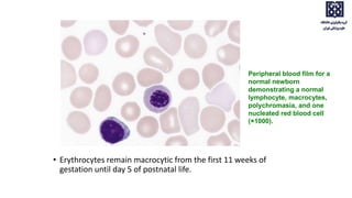 • Erythrocytes remain macrocytic from the first 11 weeks of
gestation until day 5 of postnatal life.
Peripheral blood film for a
normal newborn
demonstrating a normal
lymphocyte, macrocytes,
polychromasia, and one
nucleated red blood cell
(×1000).
 