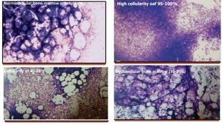 Normocellular bone marrow on aspirate High cellularity oaf 95-100%
Cellularity of 40-50% Hypocellular bone marrow (10-20%)
 