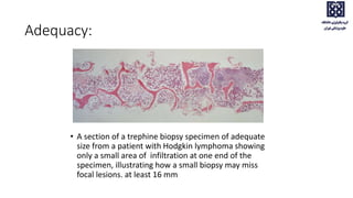 • A section of a trephine biopsy specimen of adequate
size from a patient with Hodgkin lymphoma showing
only a small area of infiltration at one end of the
specimen, illustrating how a small biopsy may miss
focal lesions. at least 16 mm
Adequacy:
 