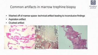 Common artifacts in marrow trephine biopsy
• Washed off of marrow space- technical artifact leading to inconclusive findings
• Aspiration artifact
• Crushed artifact
 