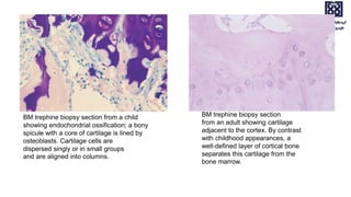 BM trephine biopsy section from a child
showing endochondrial ossification; a bony
spicule with a core of cartilage is lined by
osteoblasts. Cartilage cells are
dispersed singly or in small groups
and are aligned into columns.
BM trephine biopsy section
from an adult showing cartilage
adjacent to the cortex. By contrast
with childhood appearances, a
well‐defined layer of cortical bone
separates this cartilage from the
bone marrow.
 