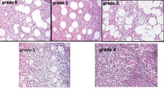 grade 0 grade 1 grade 2,
grade 3 grade 4
 