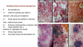 Grading of bone marrow storage iron
0 No stainable iron
1+ Small iron particles just visible in
reticulum cells using an oil objective
2+ Small, sparse iron particles in reticulum
cells, visible at lower power
3+ Numerous small particles in reticulum cells
4+ Larger particles with a
tendency to aggregate into clumps
5+ Dense, large clumps
6+ Very large clumps and extracellular iron
 