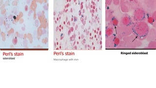 Perl’s stain
sideroblast
Perl’s stain
Macrophage with iron
Ringed sideroblast
 