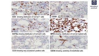 MPO showing distribution of normal myeloid cells
CD79a showing distribution of normalB cells
CD20
CD3 showing distribution of normalT cells
CD34 showing positivity of endothelial cells
CD34showing very occasional positive cells
 