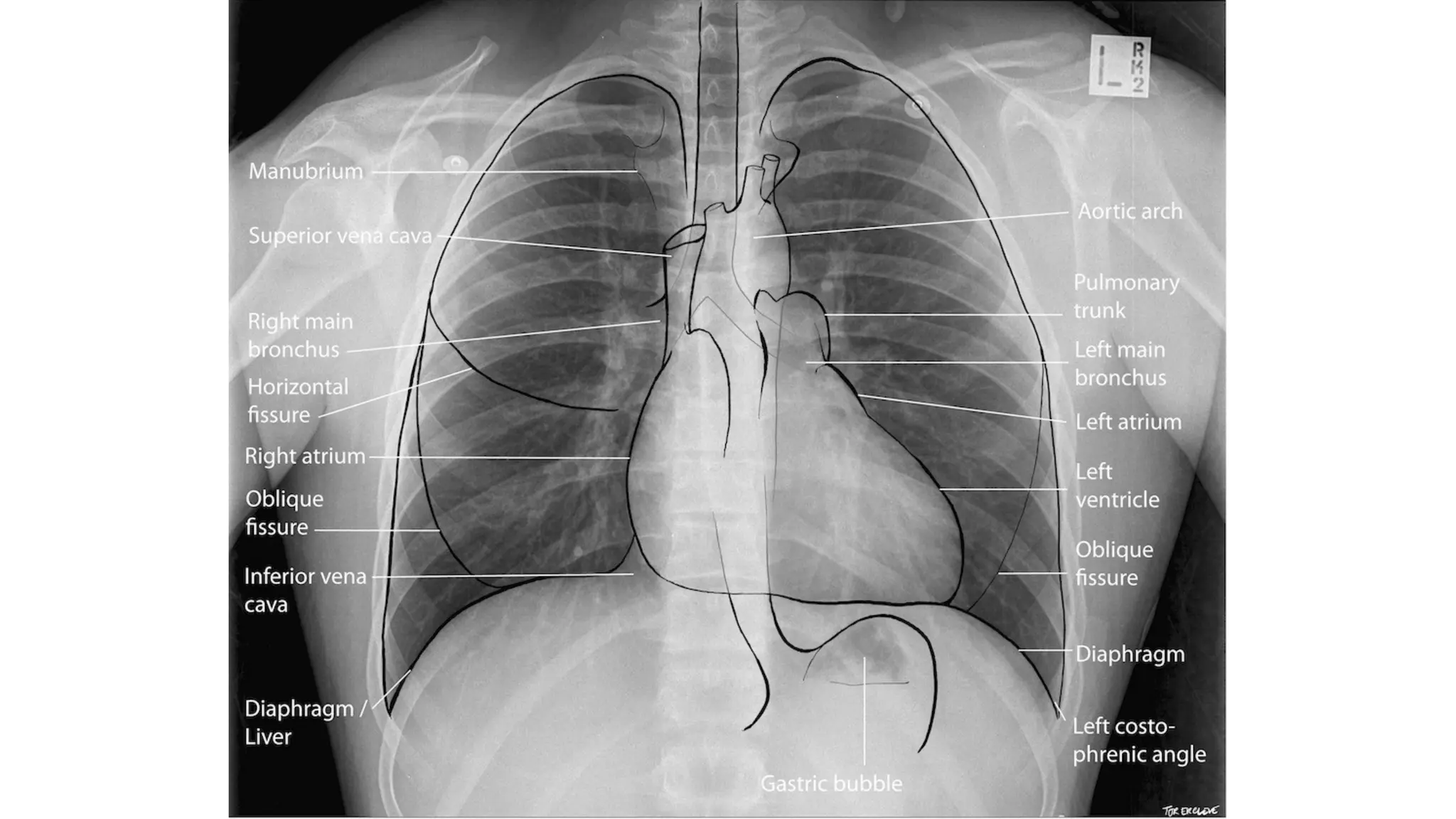Chest Xray reading 101 or Chest Radiography | PPTX