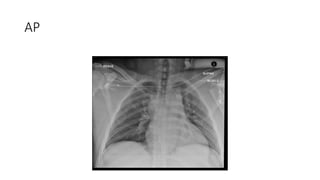 Chest Xray reading 101 or Chest Radiography | PPTX