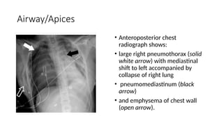 Chest Xray reading 101 or Chest Radiography | PPTX