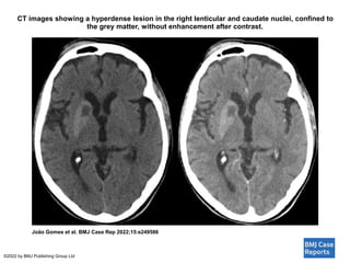 CT images showing a hyperdense lesion in the right lenticular and caudate nuclei, confined to
the grey matter, without enhancement after contrast.
João Gomes et al. BMJ Case Rep 2022;15:e249586
©2022 by BMJ Publishing Group Ltd
 