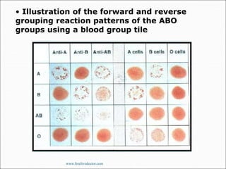 • Illustration of the forward and reverse
grouping reaction patterns of the ABO
groups using a blood group tile
www.freelivedoctor.com
 